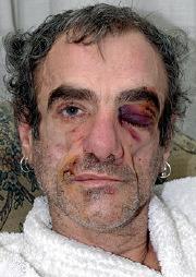 La cara de Mikel Martin con un ojo morado tras la brutal paliza recibida el jueves 15 de enero